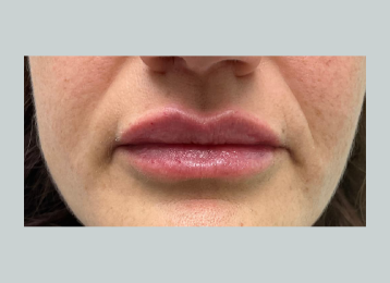 34594_lipfiller_after