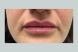 34594_lipfiller_after