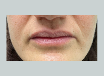 34594_lipfiller_before