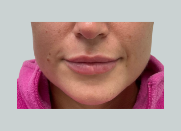 35030_lipfiller_after