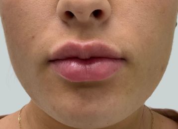 35468_lip_filler_after