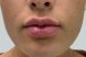 35468_lip_filler_after