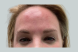 35935_female_dysport_forehead_after