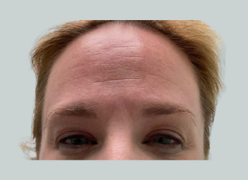 35935_female_dysport_forehead_before