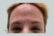 35935_female_dysport_forehead_before