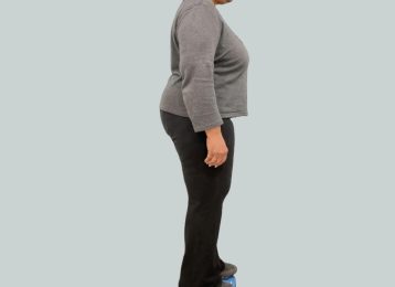 37604-medical-weight-loss-belly-legs-before