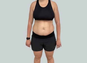 37787-medical-weight-loss-belly-after