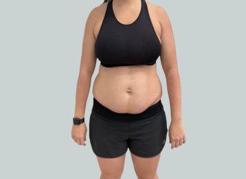 37787-medical-weight-loss-belly-before