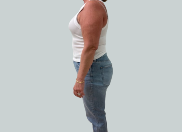 38496-medical-weight-loss-full-body-before