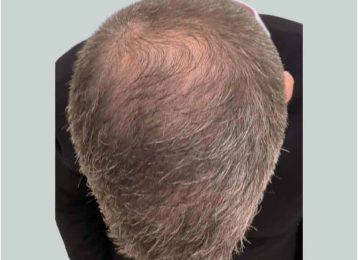 39594_microneedling_prp_hairloss_male_before