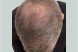 39594_microneedling_prp_hairloss_male_before