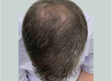 39595_microneedling_prp_hairloss_male_after