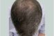 39595_microneedling_prp_hairloss_male_after