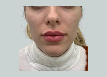 39711_lipfiller_after