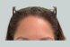 40277-intracel-forehead-female-after