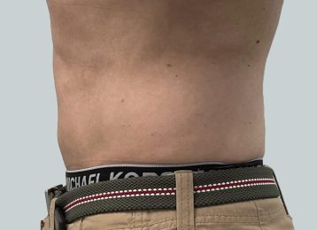 40421-coolsculpting-male-side-abdomen-after