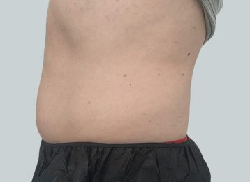 40421-coolsculpting-male-side-abdomen-before