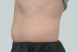 40421-coolsculpting-male-side-abdomen-before