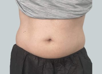 40421_coolsculpting-male-abdomen-before1