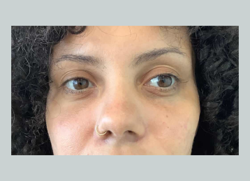 7547_undereye_filler_after