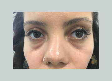 7547_undereyefiller_before