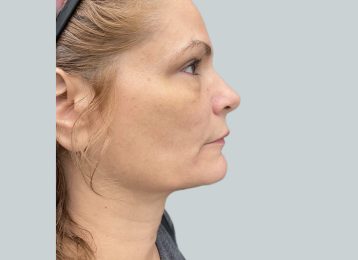 9365-coolsculpting-female-chin-after