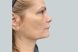 9365-coolsculpting-female-chin-after