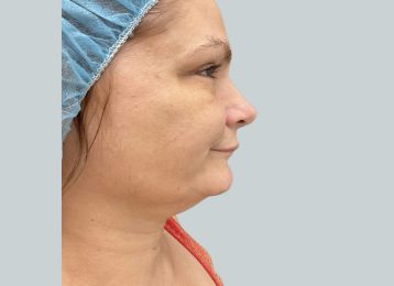 9365-coolsculpting-female-chin-before