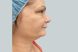 9365-coolsculpting-female-chin-before