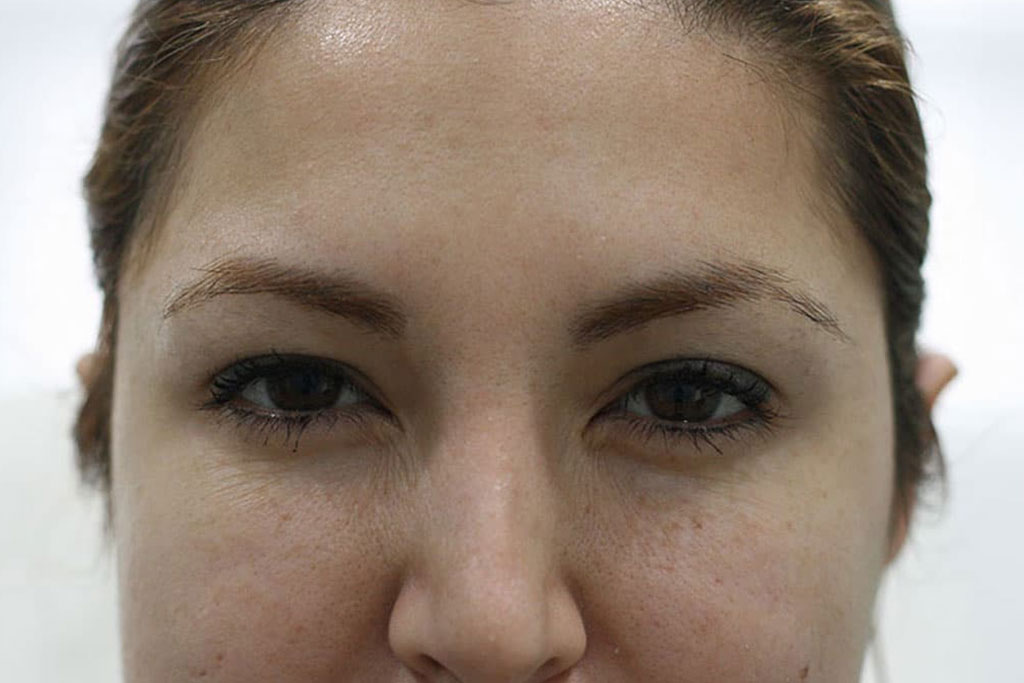 Botox Female After (3)
