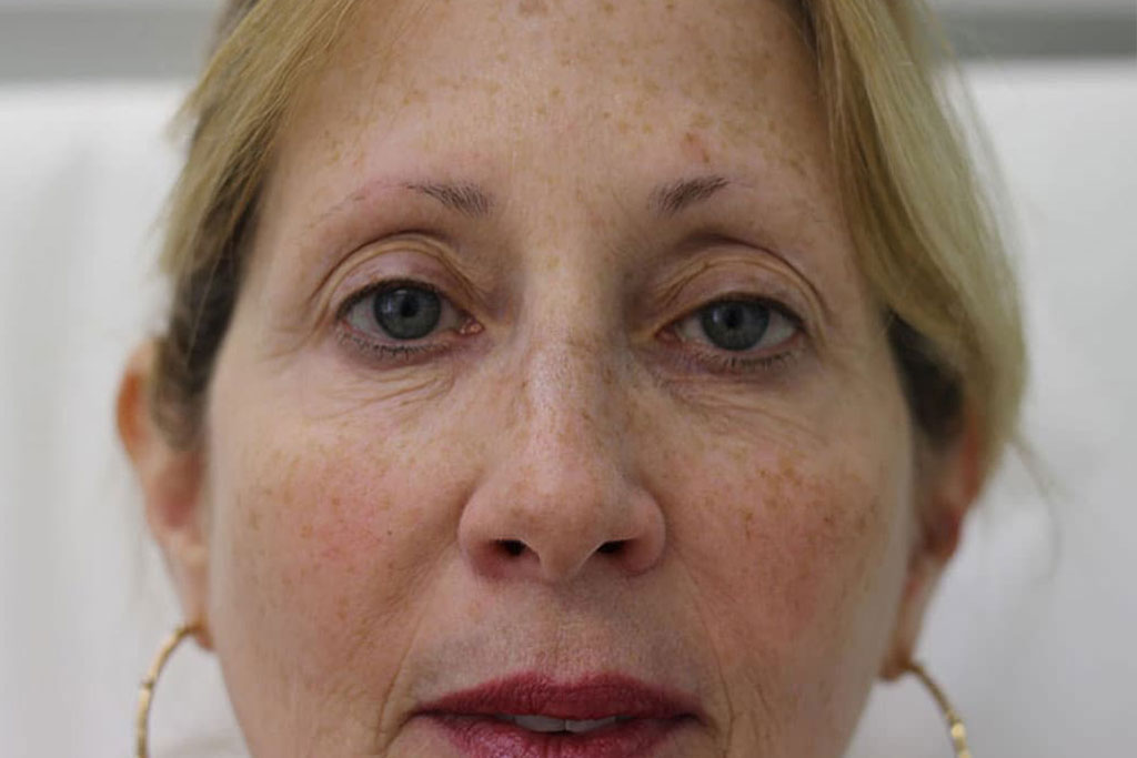 Botox Female After (4)