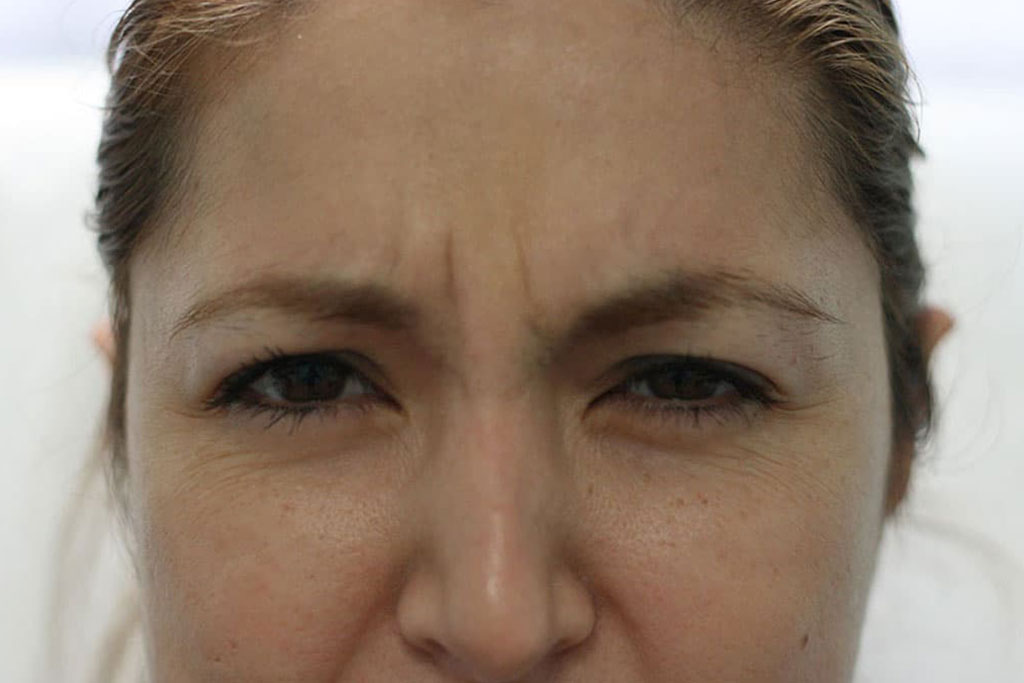 Botox Female Before (3)