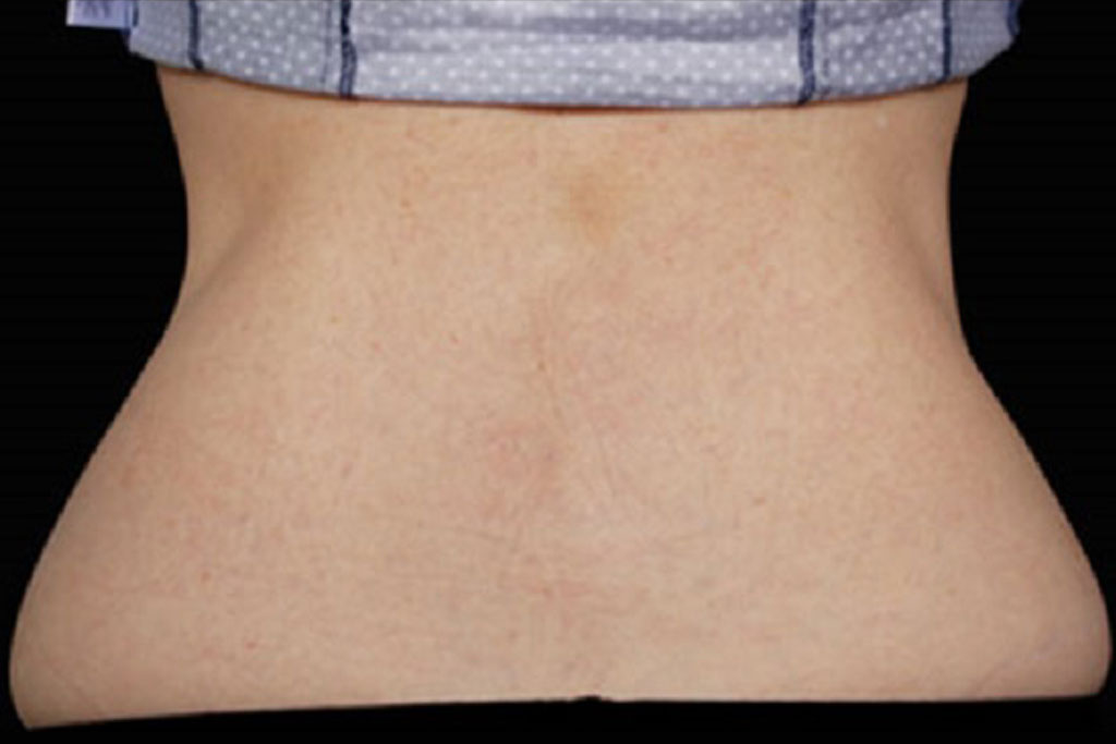 Coolsculpting Female After (2)