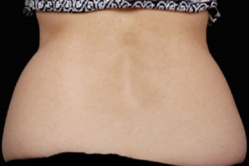 Coolsculpting Female Before (2)