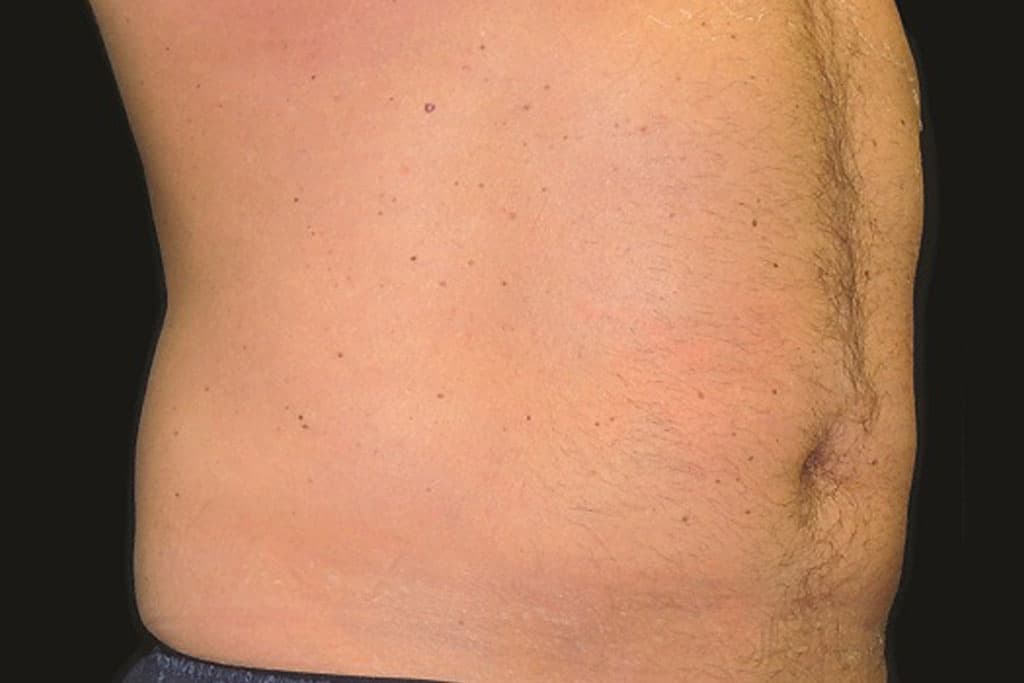 Coolsculpting Male After (2)