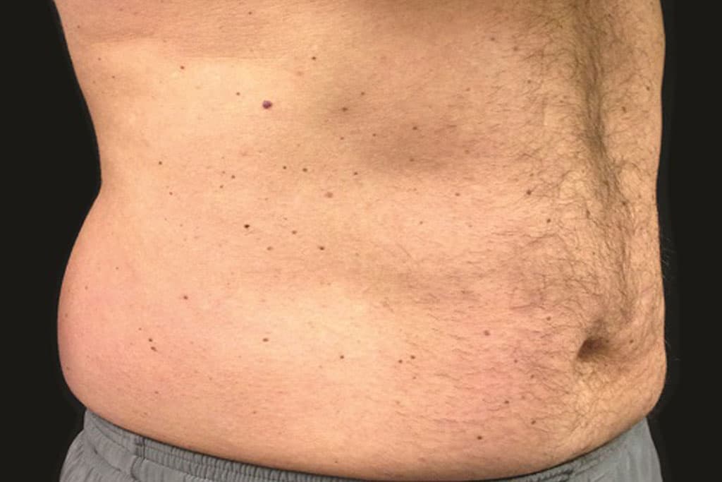 Coolsculpting Male Before (2)